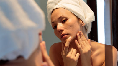 Acne Scar Treatment Do's and Don'ts