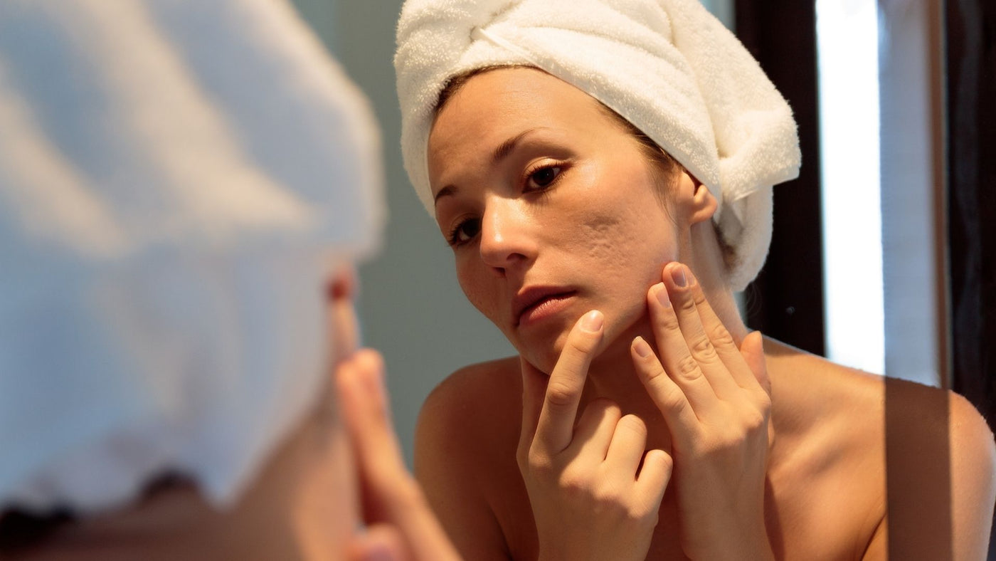Woman looking at her acne scars in the mirror